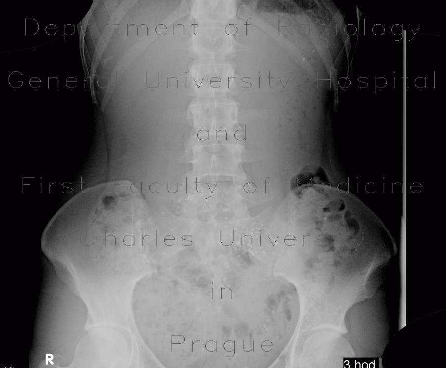 Radiology image - Colonic transit time, transit time, delayed, day one: Abdomen, Large bowel: RF - Fluoroscopy