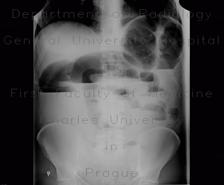 Radiology image - Colorectal cancer, carcinoma of descendens, ileus: Abdomen, Large bowel, Small bowel: X-ray - Plain radiograph
