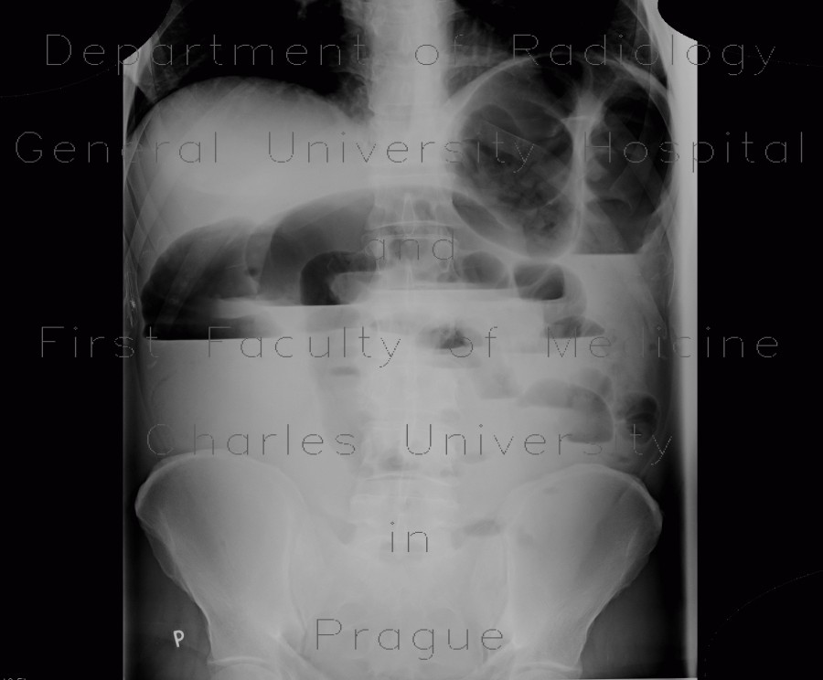 Colorectal cancer, carcinoma of descendens, ileus