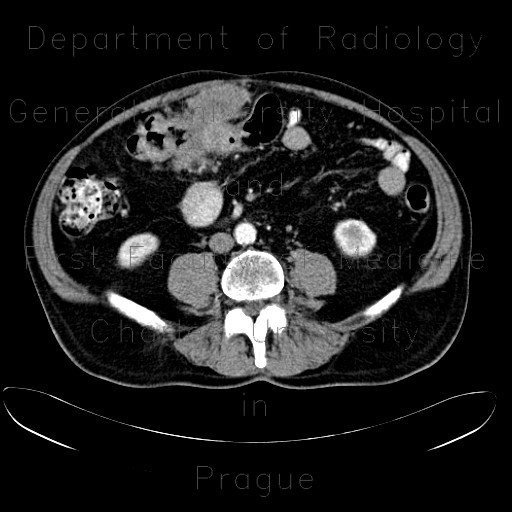 Radiology image - Colorectal cancer, carcinoma of transverse colon, extension in peritoneal cavity and abdominal wall: Abdomen, Large bowel, Peritoneal cavity, Soft tissue: CT - Computed tomography