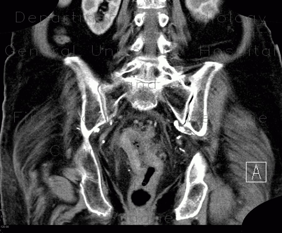 Radiology image - Colorectal cancer, tumorous stenosis of sigmoid colon, placement of stent: Abdomen, Large bowel: CT - Computed tomography