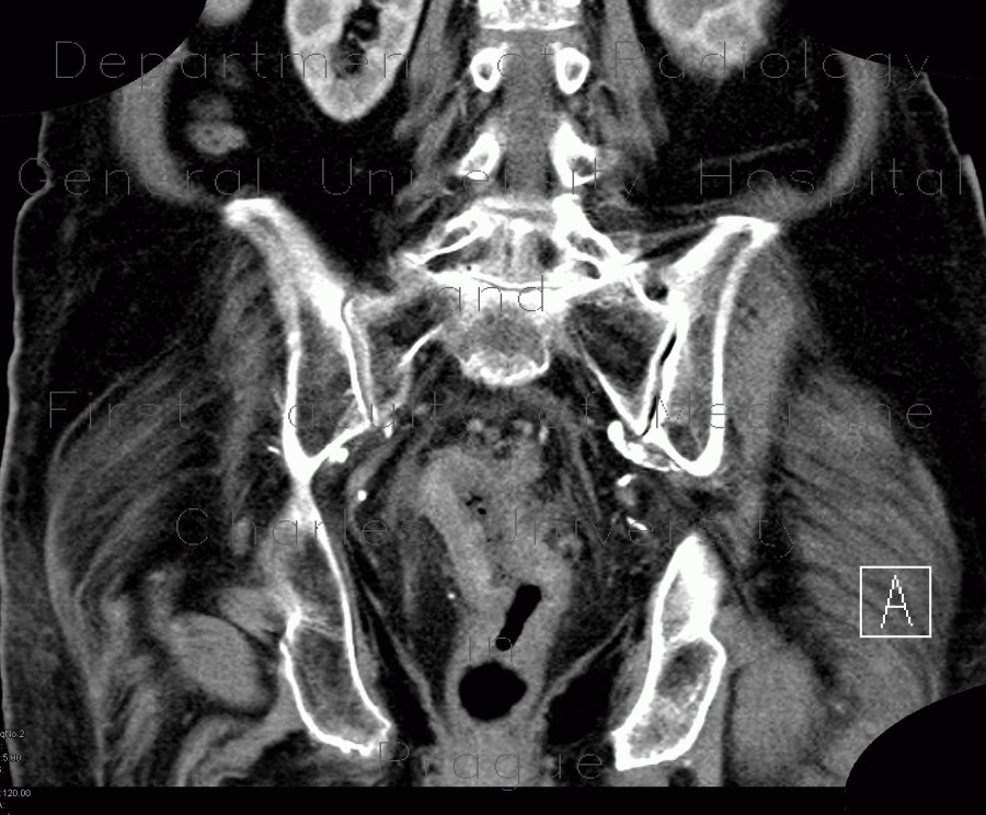 Colorectal cancer, tumorous stenosis of sigmoid colon, placement of stent