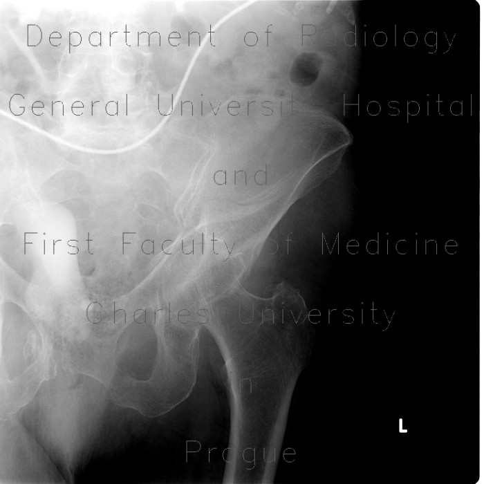 Comminuted fracture of acetabulum and pubic bone, central dislocation of femoral head