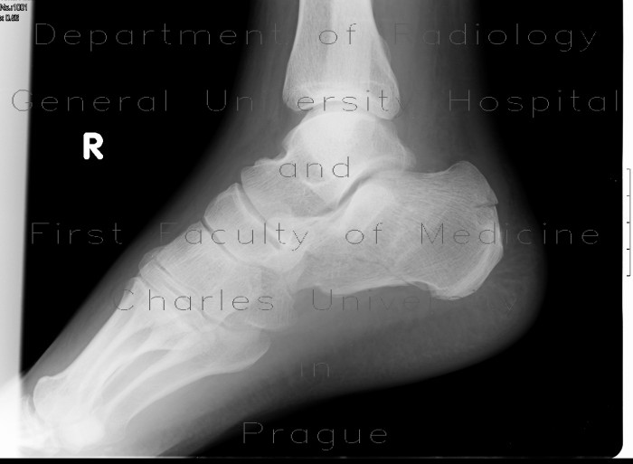 Comminuted fracture of calcaneus