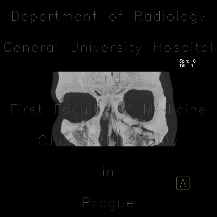 Comminuted fracture of facial skeleton