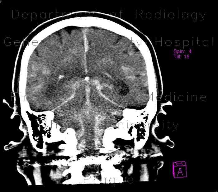 Comminuted fracture of skull base, frontal sinus, sphenoid sinus, hemosinus, pneumocephalus, contusion, subarachnoid hemorrhage