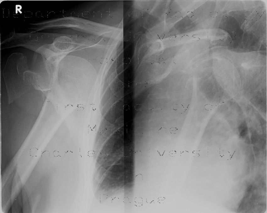 Comminuted fracture of the head of humerus