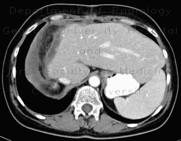 Radiology image - Compensatory enlargement of left liver lobe after resection of right liver lobe: Abdomen, Liver: CT - Computed tomography