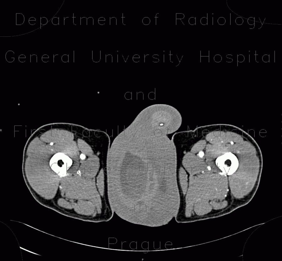 Complication of angiography, bleeding from groin, hematoma in scrotum, hemorrhage