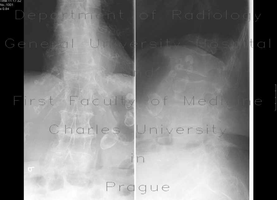 Radiology image - Compression fracture, first lumbar vertebra, osteoporosis: Spine and Axial, Bone: X-ray - Plain radiograph