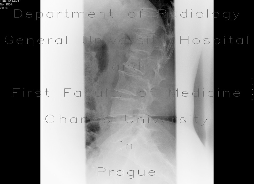 Compression fracture of lumbar vertebra