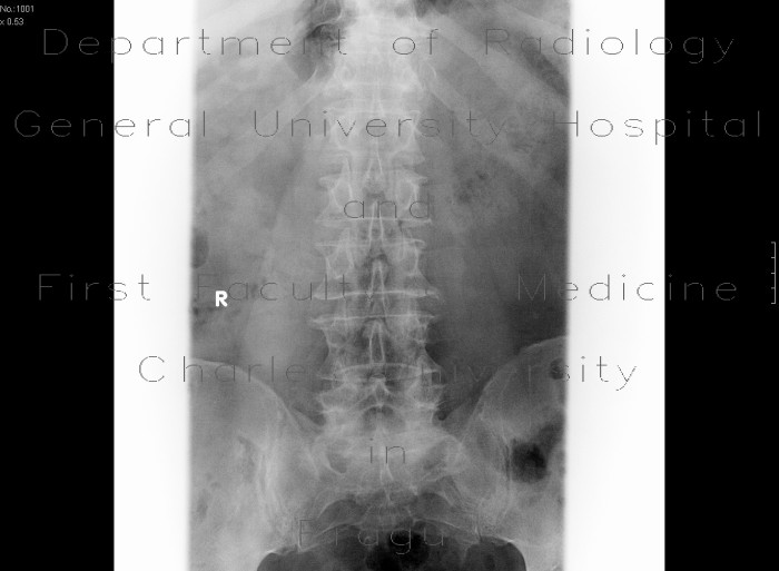 Compression fracture of lumbar vertebra