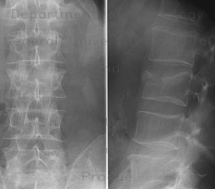 Compression fracture, Radiology Case