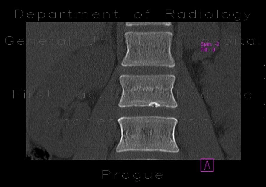 Compression fracture of lumbar vertebra