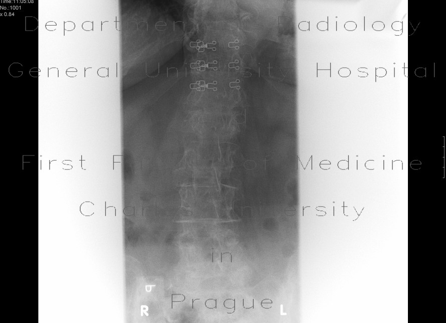 Radiology image - Compression fracture, second lumbar vertebra: Spine and Axial, Bone: X-ray - Plain radiograph