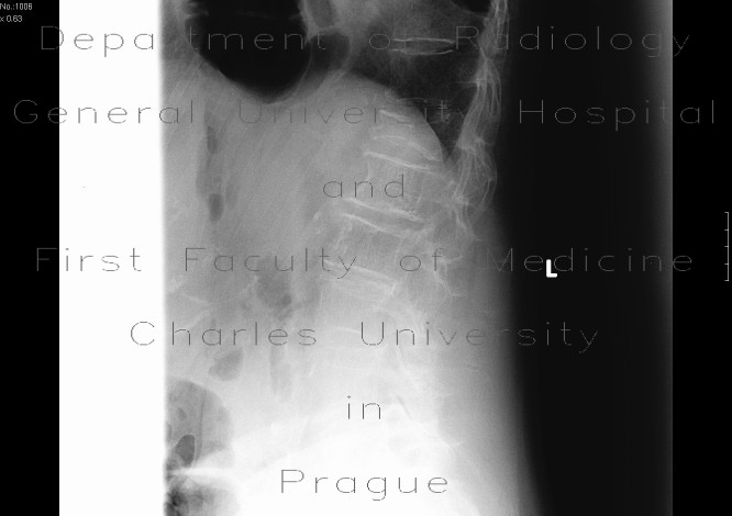 Radiology image - Compression of thoracic vertebra, osteoporosis: Spine and Axial, Bone: X-ray - Plain radiograph