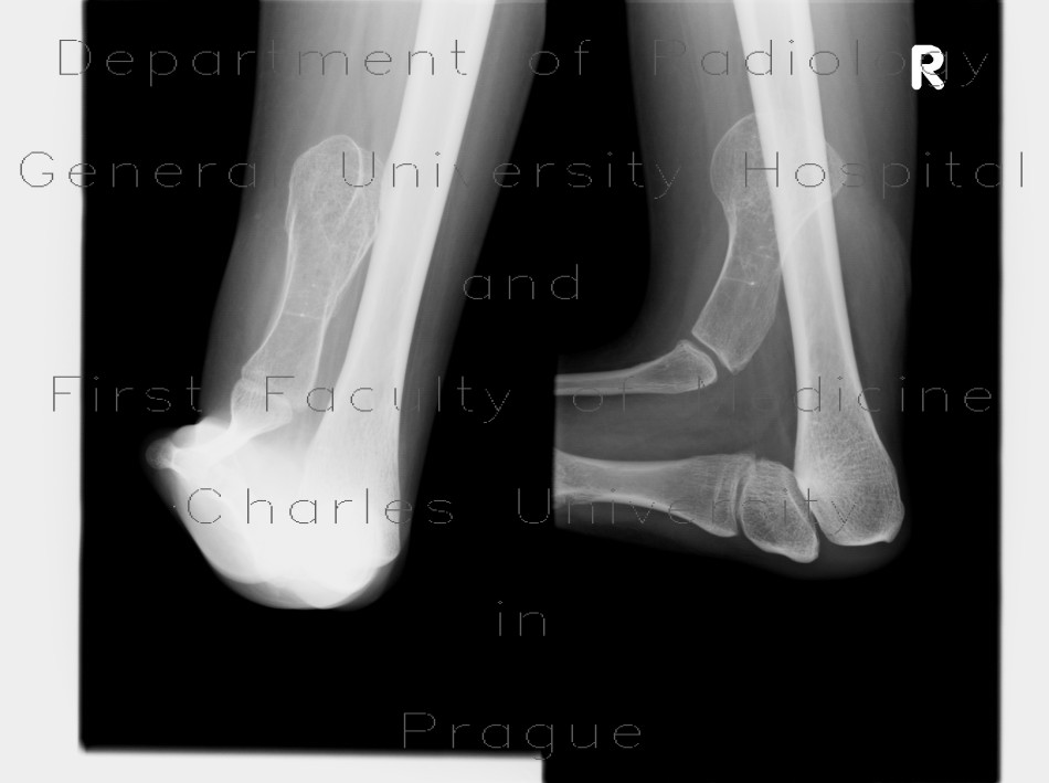 Congenital malformation of foot