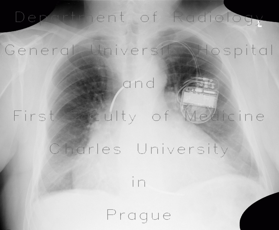 Congestive hepatopathy, biphasic flow in portal vein, heart failure, congestion