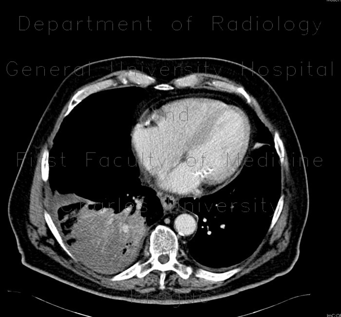 Radiology image - Consolidation of lung parenchyma: Thorax, Lung: CT - Computed tomography
