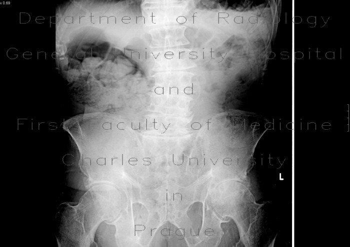 Radiology image - Constipation: Abdomen, Large bowel: X-ray - Plain radiograph