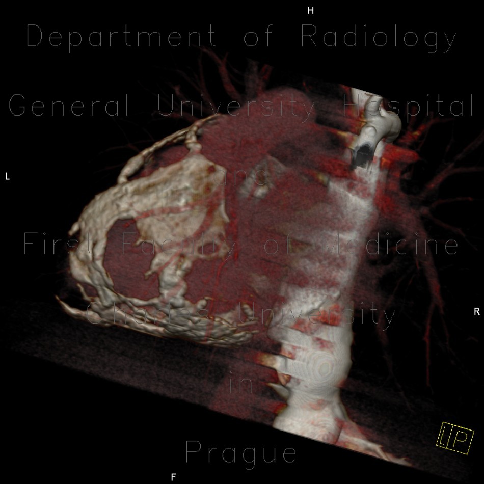 Radiology image - Constrictive pericarditis, VRT: Thorax, Heart: CT - Computed tomography