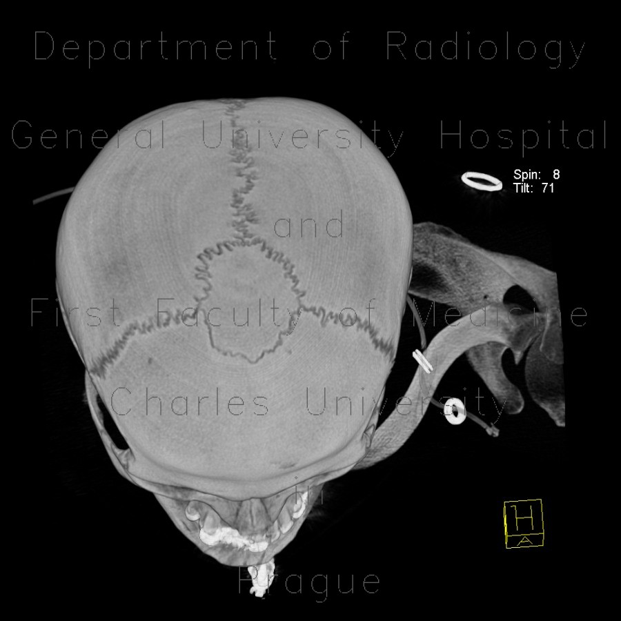 Coronal suture, bone island