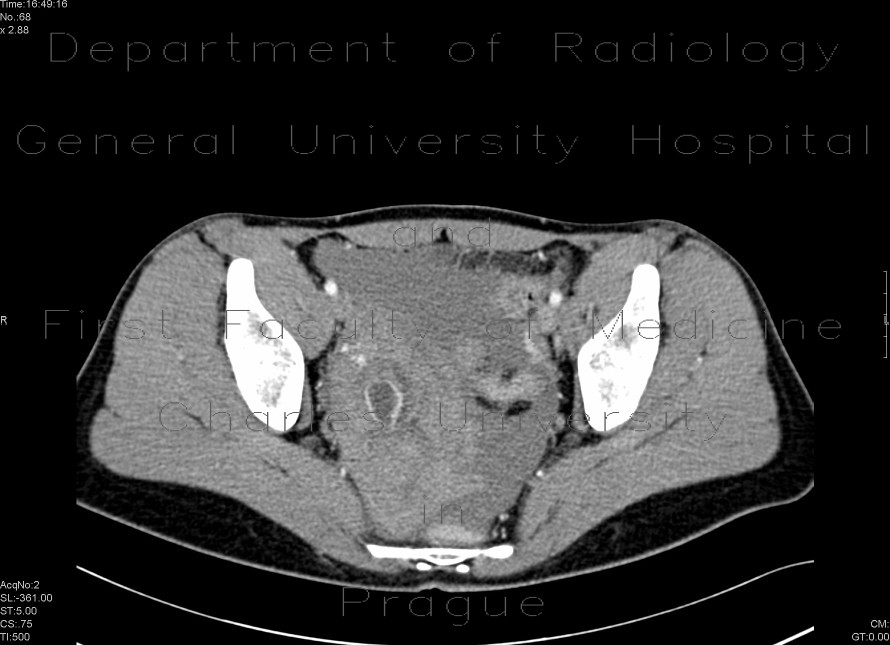 Radiology image - Corpus luteum cyst: Abdomen, Gynecology: CT - Computed tomography