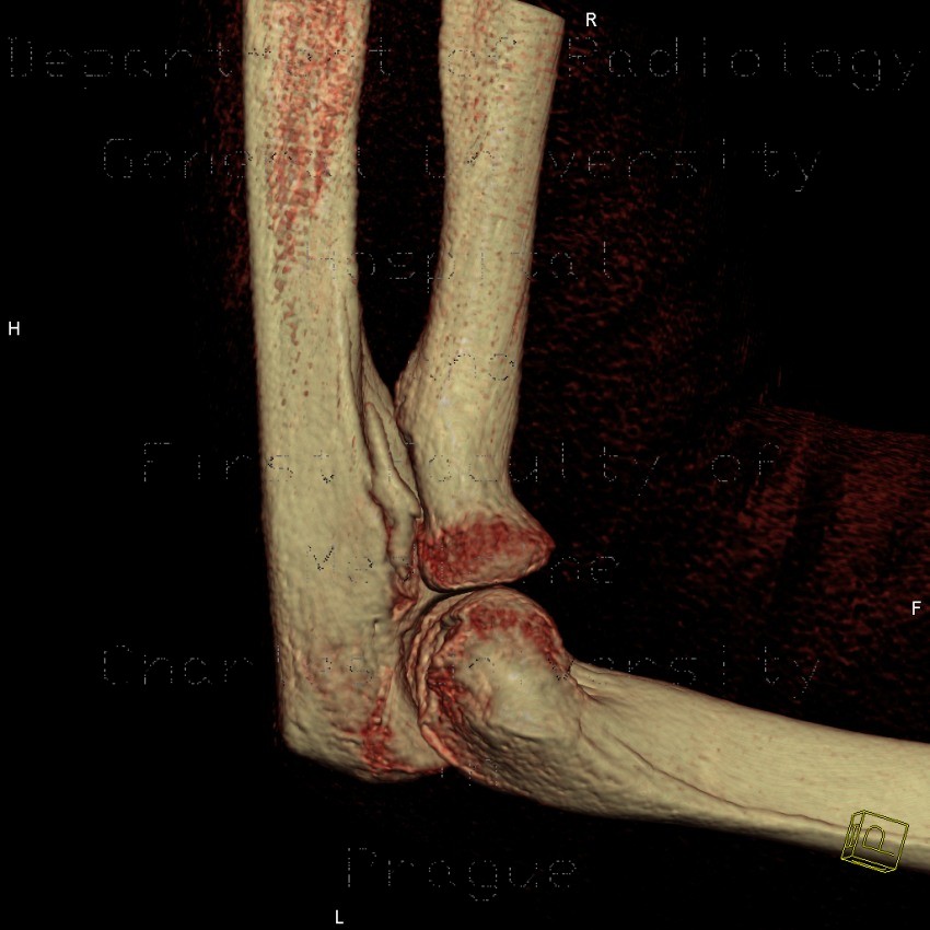 Radiology image - Cortical fragment from ulna, VRT: Extremity, Bone: CT - Computed tomography