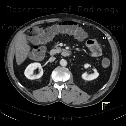 Cortical scar of the kidney, agenesis of cortex of kidney, gallstone