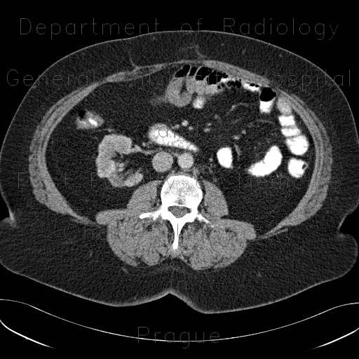 Radiology image - Cortical scars of kidney: Abdomen, Kidney and adrenals: CT - Computed tomography