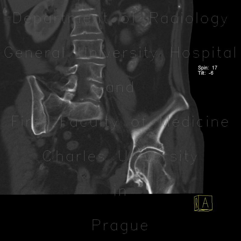 Radiology image - Coxarthrosis, Wiberg