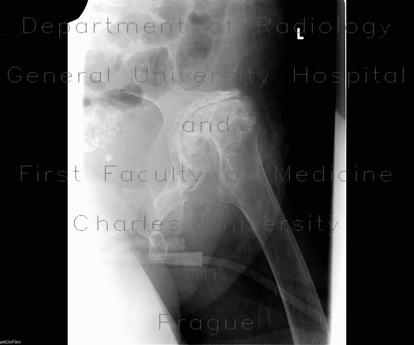 Radiology image - Coxarthrosis, advanced: Extremity, Bone: X-ray - Plain radiograph