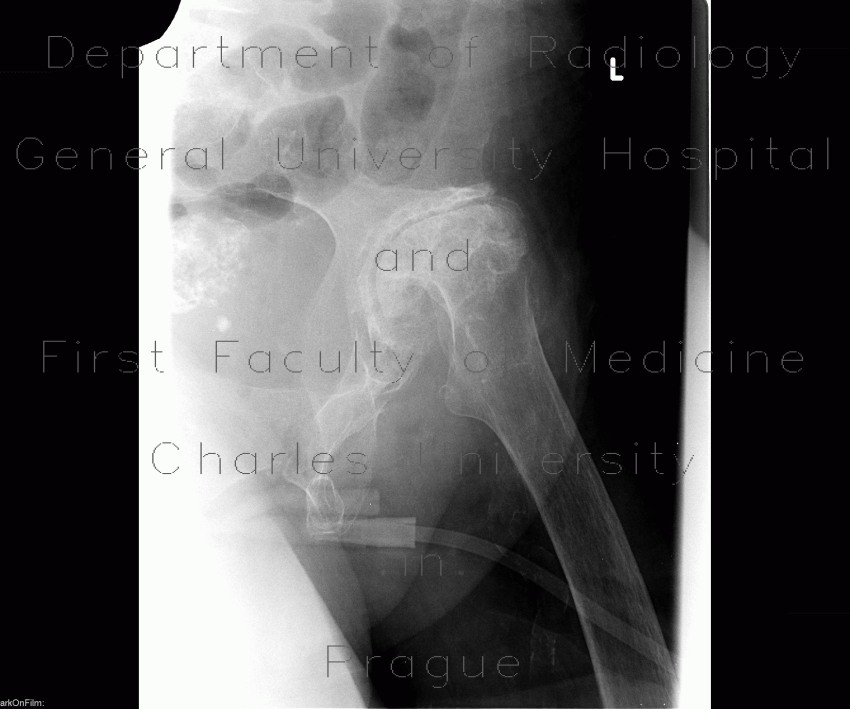 Coxarthrosis, advanced