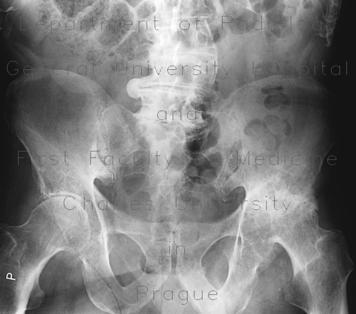 Radiology image - Coxarthrosis, severe: Extremity, Bone: X-ray - Plain radiograph
