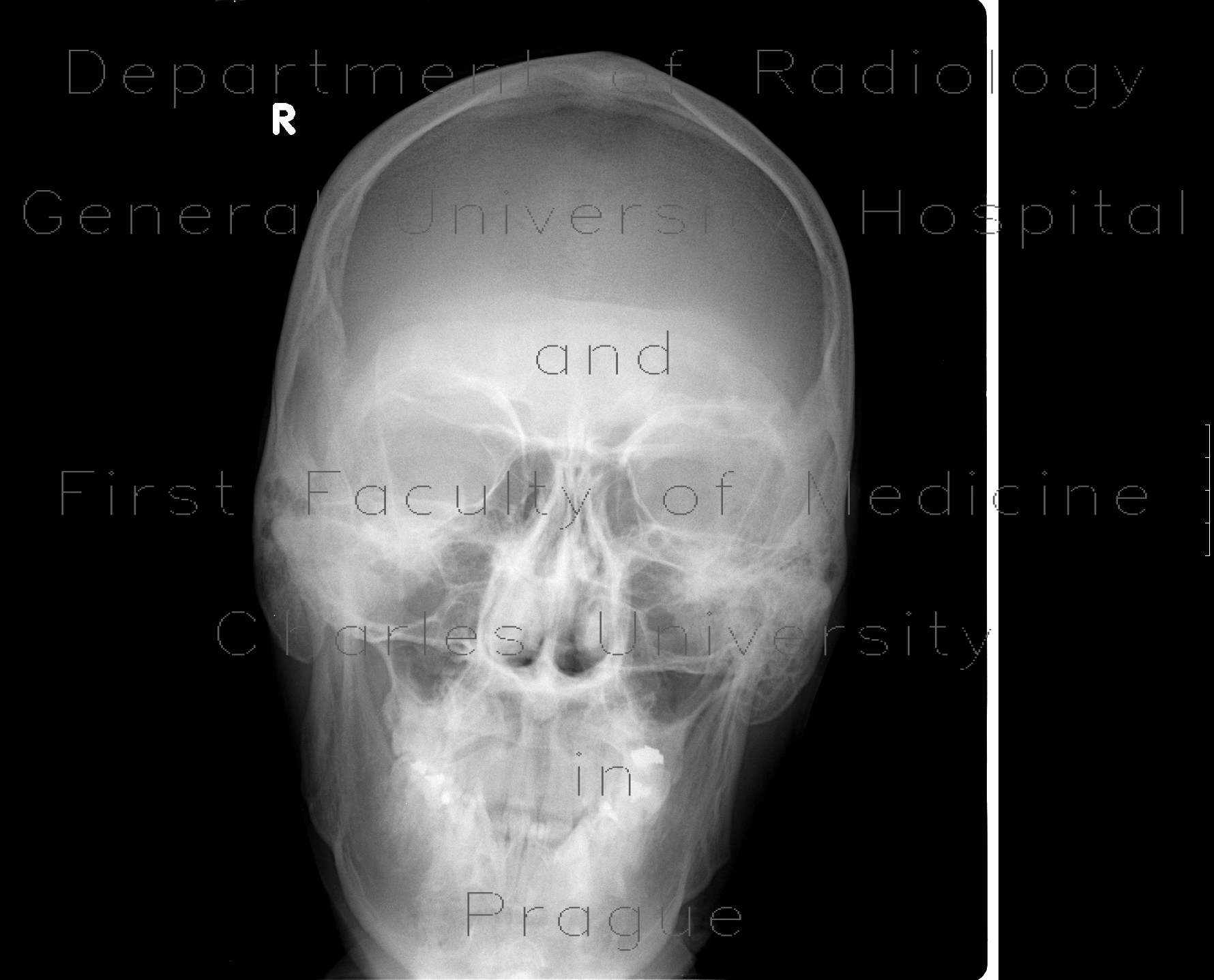 Craniotomy