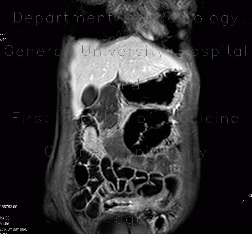 Crohn's disease, MR enterography