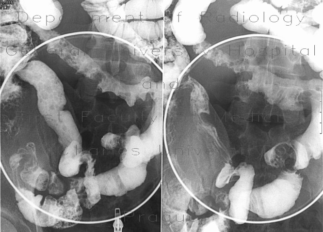 Crohn's disease, aboral ileum, enteroclysis