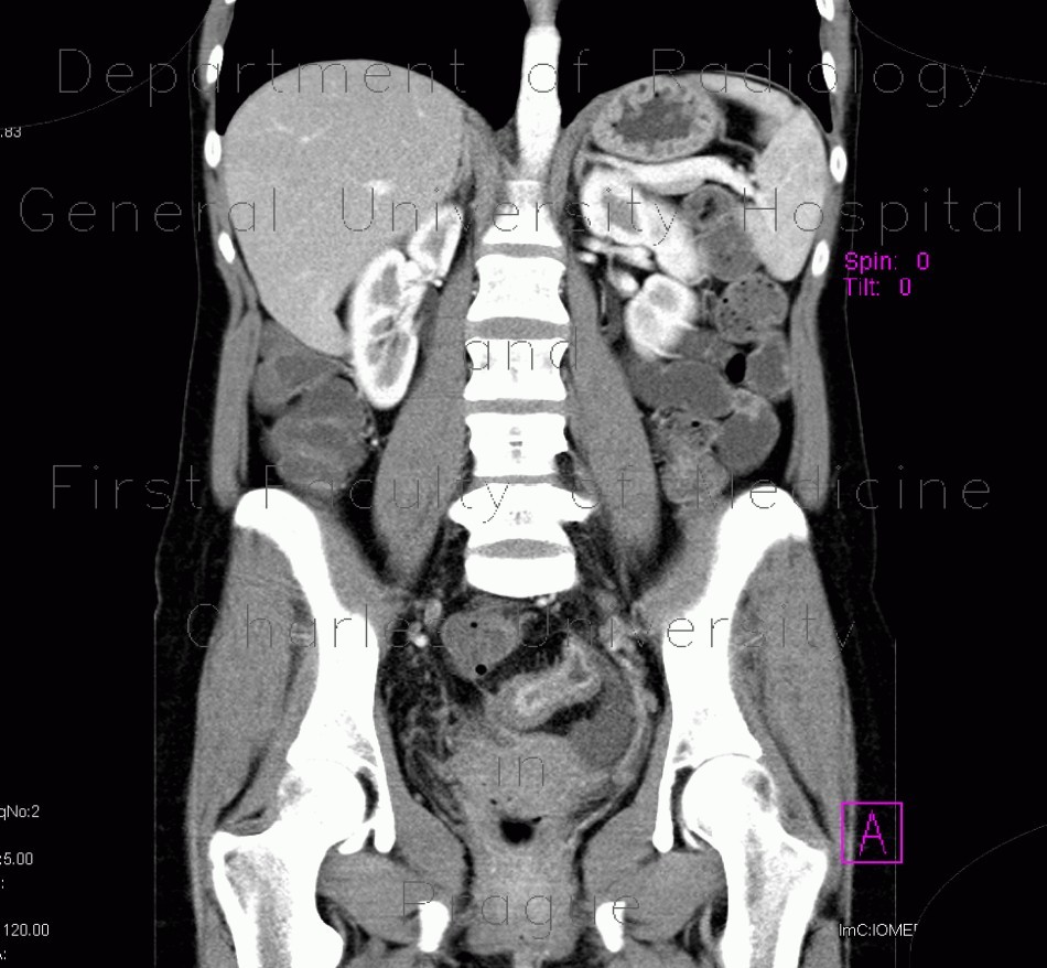 Crohn's disease, acute inflammation, ascites, CT enterography