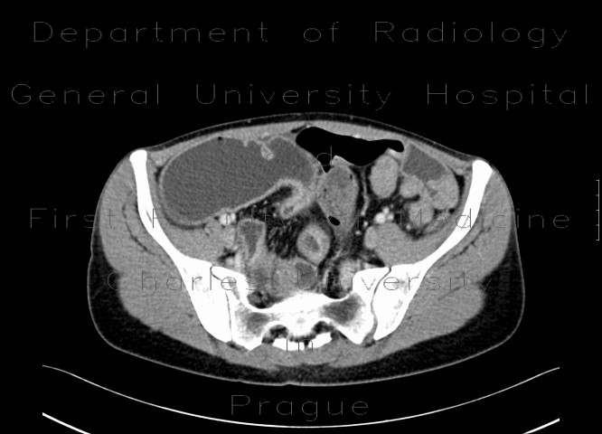 Crohn's disease, chronic ileus due to multiple stenoses, enterography