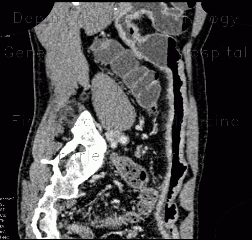 Crohn's  disease, cobble stone