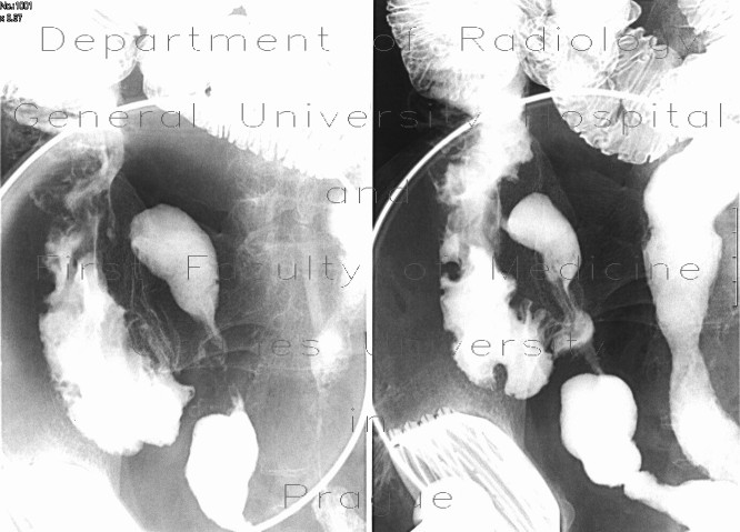 Crohn's disease, enteroclysis