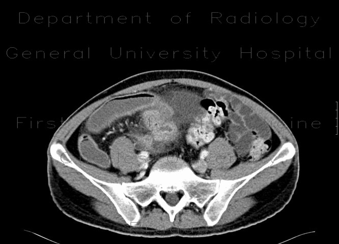 Crohn's disease, enterovesical fistula