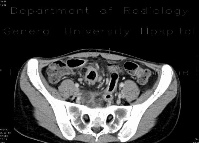 Crohn's disease, extensive involvement of small bowel, fistulae, abscess - Enterography