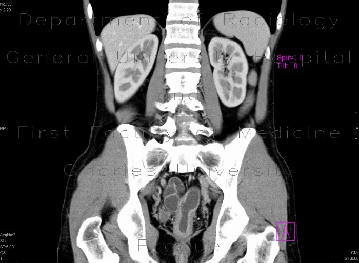 Crohn's disease, ileocecal resection, subtotal colectomy, recurrence