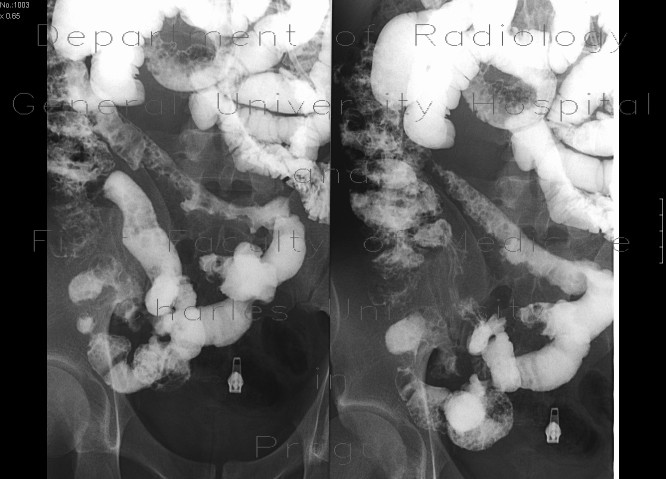 Crohn's disease of ileum