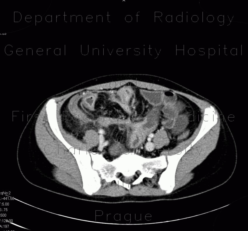 Crohn's disease of ileum, CT enterocysis, 2009