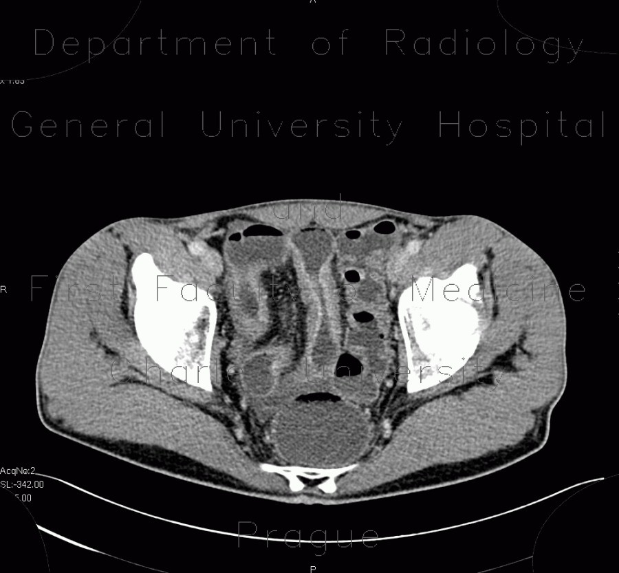 Crohn's disease of ileum, CT enterography and MR enterography