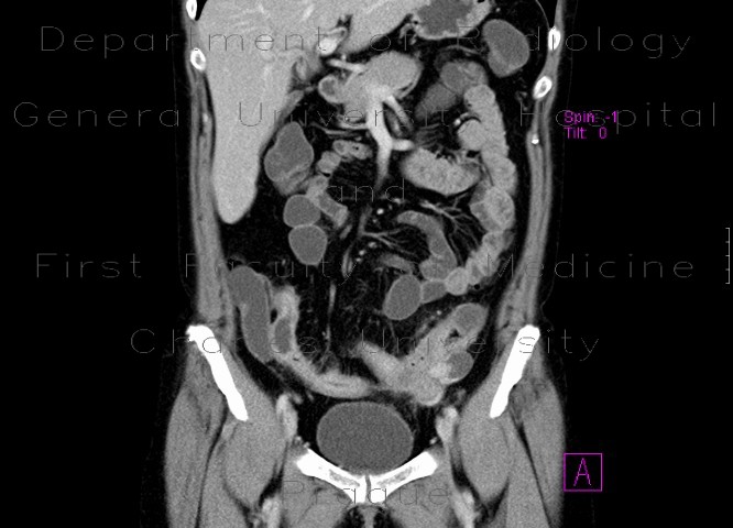 Crohn's disease of small bowel, inflammatory stenosis of the sigmoid colon