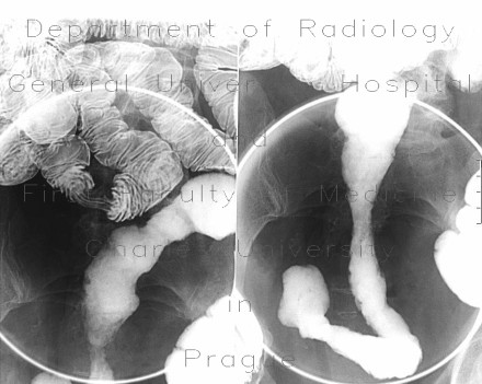 Crohn's disease of terminal ileum