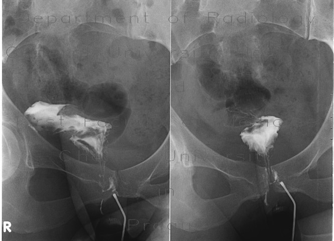 Crohn's disease, periproctal fistula communicating with rectum - fistulography